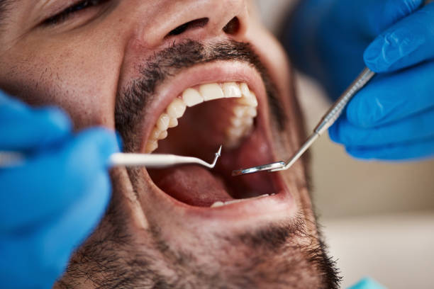 Best Emergency Tooth Extraction in Summit, IL